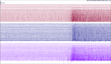 Why Electrophysiology Matters for Brain Organoid Disease Modeling